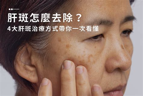 顴骨長斑|一次解析曬斑、肝斑、雀斑、顴骨母斑等皮膚黑斑原因…